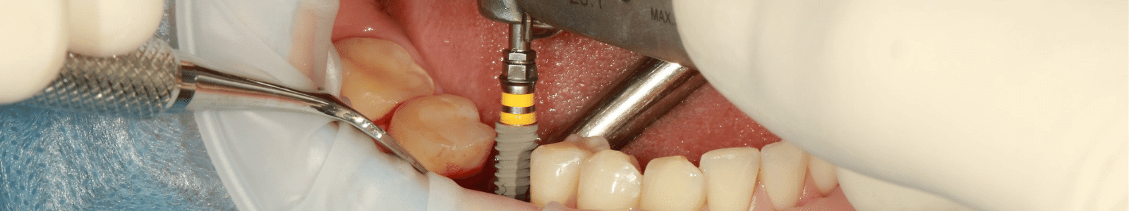 dental implant surgery